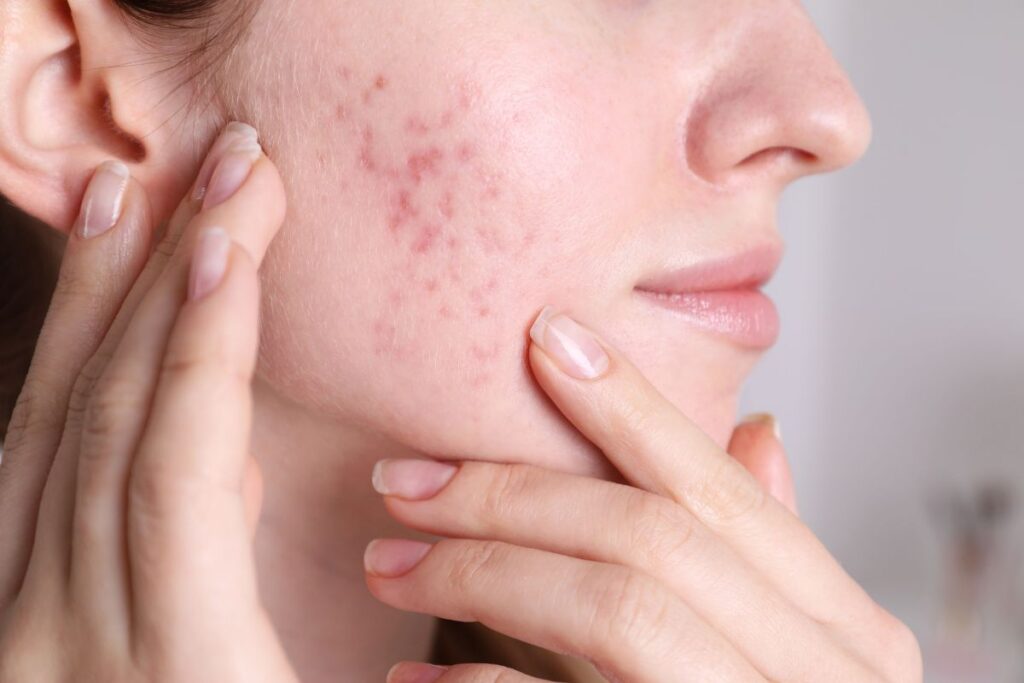 Tầm quan trọng của việc chăm sóc da mụn đúng cách
